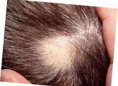 Миноксидил или пересадка волос. Есть ли альтернатива?